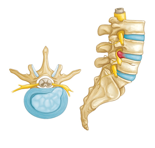back pain from intervertebral hernia