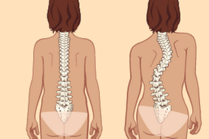 standing posture and scoliosis with thoracic osteochondrosis