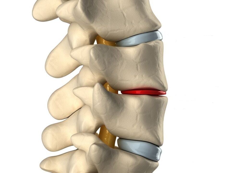 Healthy (blue) and damaged intervertebral disc due to thoracic osteochondrosis (red)
