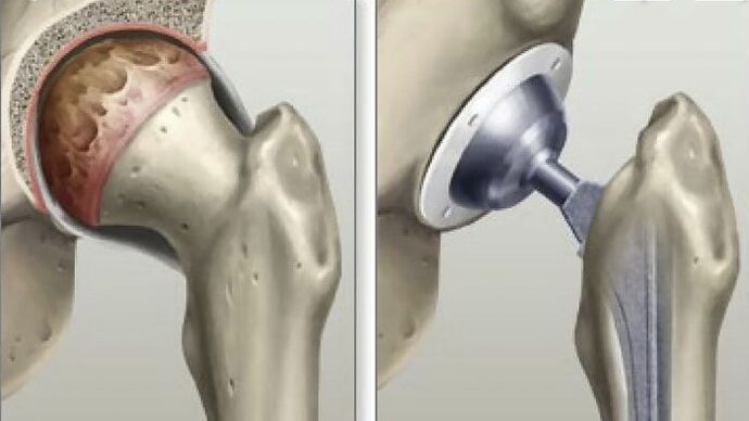Hip replacement performed in the final stages of coxarthrosis