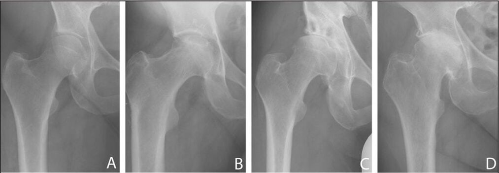 Stages of development of arthrosis of the hip joint on an x-ray
