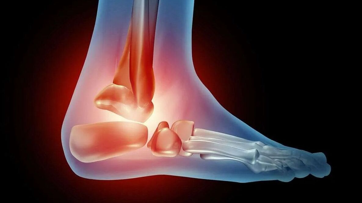 ankle arthritis diagram
