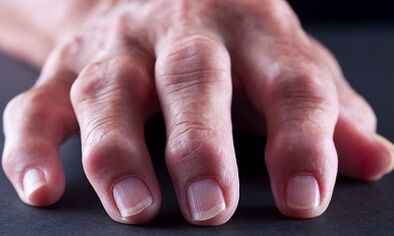 What is the difference between arthritis from osteoarthritis