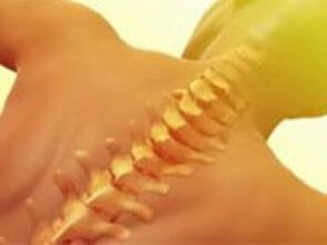 Osteochondrosis - Vertebral column disease