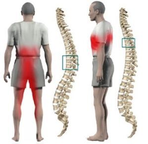 Bumps in the spine