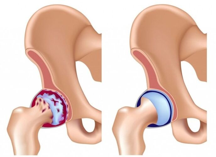 Damage to the hip joint due to osteoarthritis