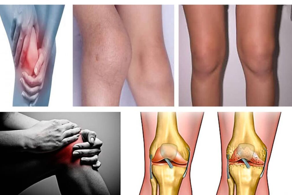arthrosis what is it