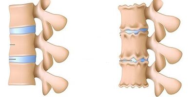 How to recognize the presence of osteochondosis of the lumbar