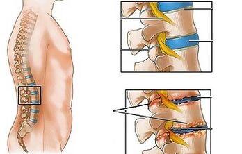 The causes of osteochondosis of the lumbar
