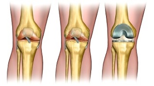 endoprosthesis for osteoarthritis of the knee joint